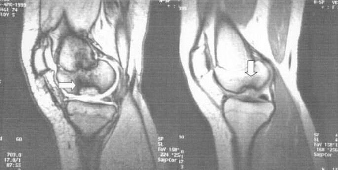 rendgenski snimak disekane osteohondroze u zglobu koljena