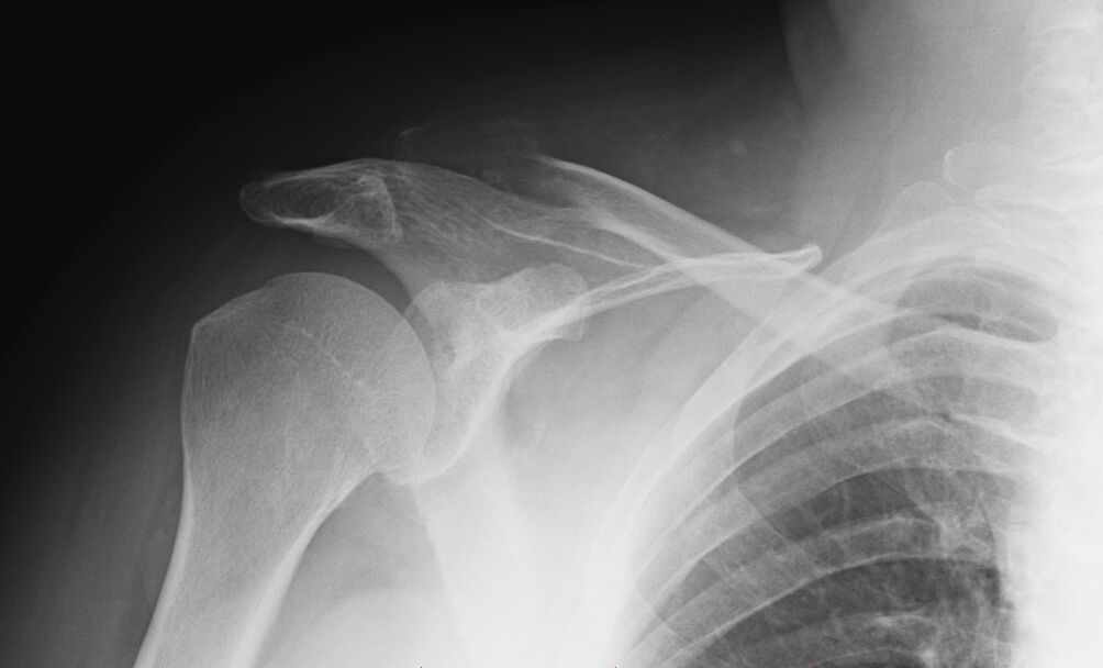 rendgenski snimak artroze ramena