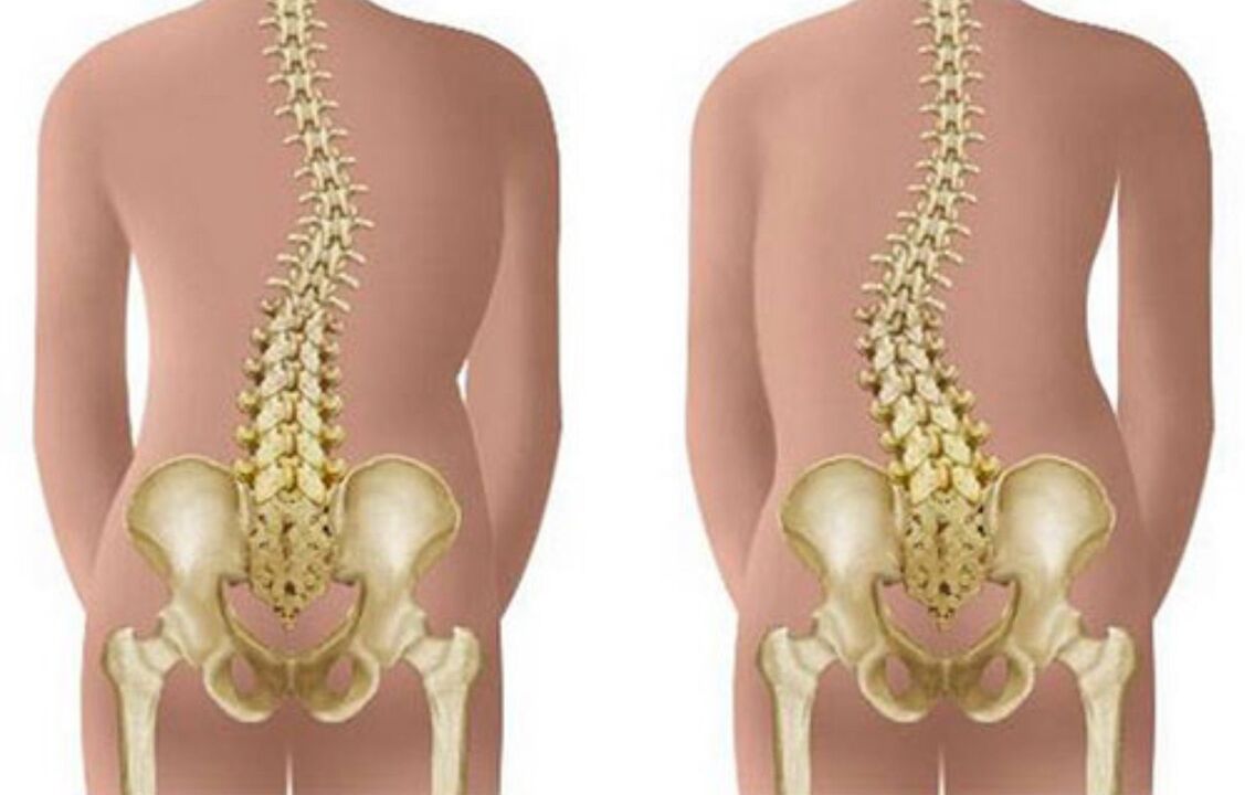 skolioza kao uzrok bolova u leđima u predjelu lopatica