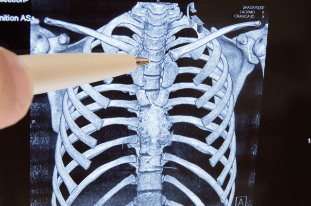 Osteohondrosis